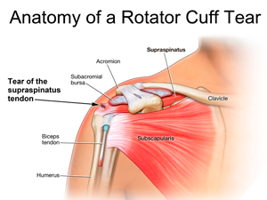 Rotator Cuff Tear (RCT)