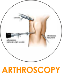 ARTHROSCOPY