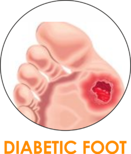 DIABETIC-FOOT