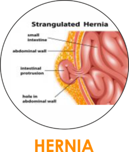 HERNIA