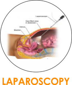 LAPAROSCOPY