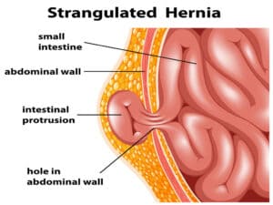 hernia-300x225