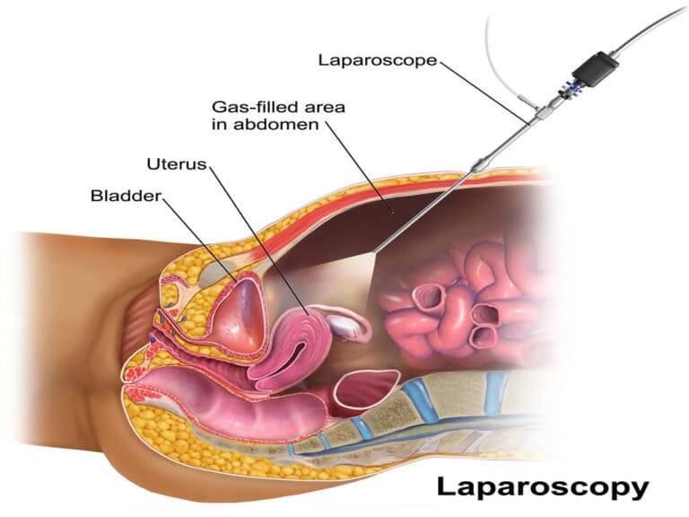 laparoscopy-768x576